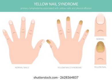 Yellow Nail Syndrome is a rare condition marked by thick, slow-growing yellow nails, often with lymphedema and respiratory issues. Medical infographic. Vector illustration