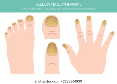 A Síndrome das Unhas Amarelas é uma condição rara marcada por unhas amarelas grossas e de crescimento lento, muitas vezes com linfedema e problemas respiratórios. Infográfico médico. Ilustração vetorial