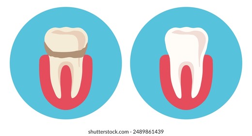 Yellow tooth with tartar and white healthy tooth. Vector illustration.