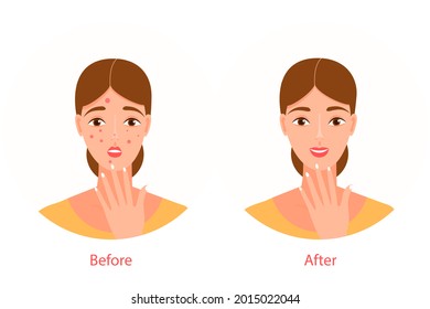A young beautiful woman with red pimples on her face. Before and after illustration, in a flat cartoon style. The girl is upset, happy. Acne treatment. Vector isolated on a white background