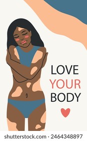 Young black girl with vitiligo. Love your body concept. Modern vector illustration