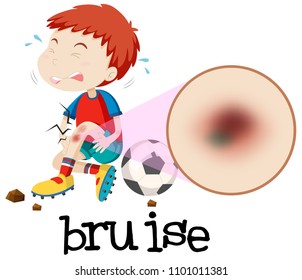 A Young Boy Habing Bruise illustration