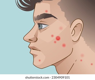 The young boy with skin problems.  Acne problems, damaged skin. Healthcare illustration. Vector illustration.