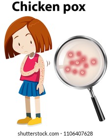 Young girl with Chicken Pox illustration