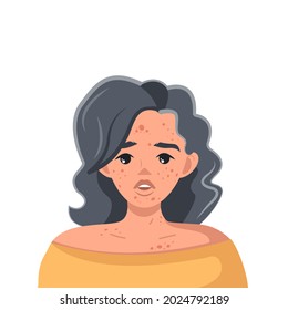 A young girl has problematic skin, pimples and acne. A female character with pimples on her face and body. Vector illustration