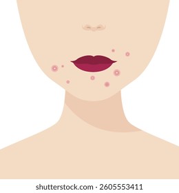 Young girl has skin problems with acne or allergic pimples on her face. Skincare and dermatology concept. Flat style vector illustration.