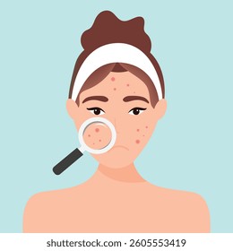 Young girl has skin problems with acne or allergic pimples on her face. Skincare and dermatology concept. Flat style vector illustration.