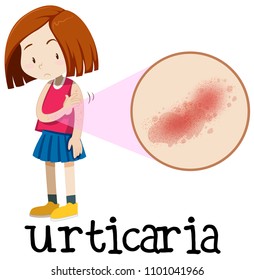 A Young Girl Having Urticaria illustration
