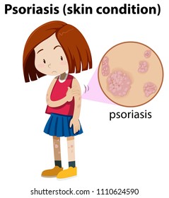 Young Girl With Magnified Psoriasis Illustration