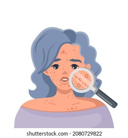 A young girl with problematic skin on her face. Pimples and Acne. A girl using a magnifying glass to find pimples on her face. Vector illustration in cartoon style isolated on a white background