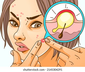 The young girl with skin problems. Pimple-popping. Pimple problems. Healthcare illustration, medical infographic. Vector illustration.