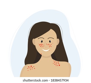 Young Girl With Skin Rashes On The Face, A Symptom Of Lupus Erythematosus. Vector Illustration In Flat Style