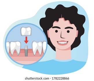 Young girl smiles after orthodontic therapy and dental implant as a concept of orthodontic services, implantation, prosthetics. Flat vector stock illustration with prosthesis and girl with smile