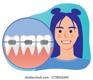 Young girl smiles with braces as a concept of dental services, visit to the orthodontist, braces care and dental health. Flat vector stock illustration with woman and braces for orthodontic clinic