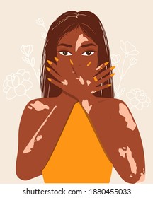 A young girl with Vitiligo skin problems covers her face with her hands. Body positive, self-love, depigmentation disease. World vitiligo day.