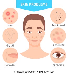 young guy with problem skin - pimples, black dots, wrinkles, dark circles, dry skin.