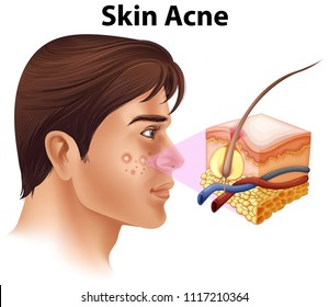A Young Man with Acne Problem illustration