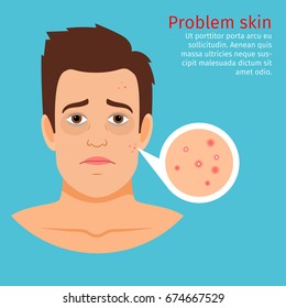 Young man face problem skin with acne, vector illustration