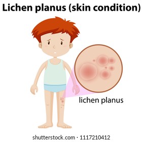 Ein junger Mann mit Lichen Planus-Illustration