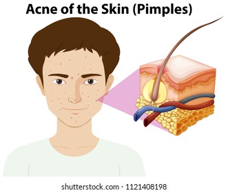 A Young Man with Pimple on Face illustration