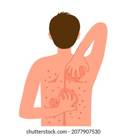 Young Man Scratching His Back. Guy Suffering From Strong Allergy Skin Itchy Symptom In Flat Design. Red Rash Skin Irritation.