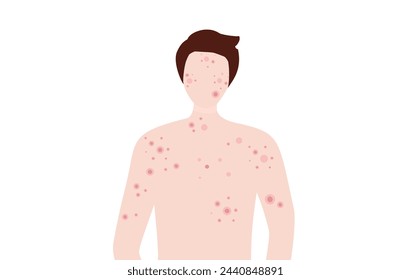 Hombre joven con acné de la piel, granos, puntos negros ilustración vectorial. Concepto de problema de piel de acné