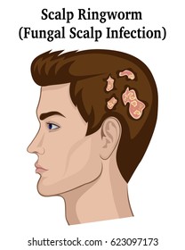 A young man with symptoms of a fungal infection of the scalp (ringworm)