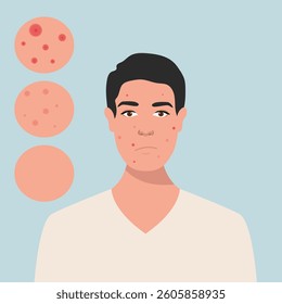 Young men has skin problems with acne or allergic pimples on her face. Skincare and dermatology concept. Flat style vector illustration.
