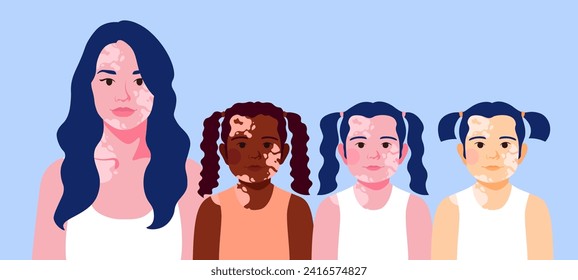 Young mother and daughters with vitiligo. Copy space template, motherhood or love concept. Banner on the theme of family. Flat vector illustration of people and children with skin features.