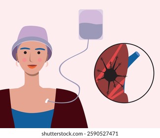 Young patient with chemotherapy as oncology concept, flat vector stock illustration with cancer patient with metastases