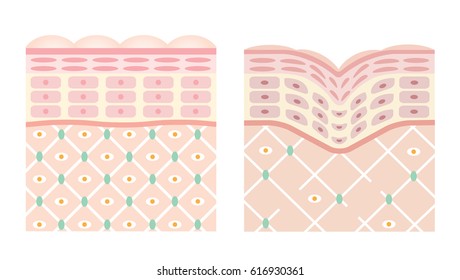 young skin is firm tight, its collagen framework is healthy. old skin sags as it loses its support structure/diagrams of young skin and old skin