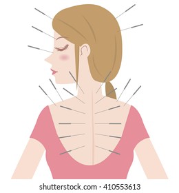 young woman and acupuncture therapy, image illustration