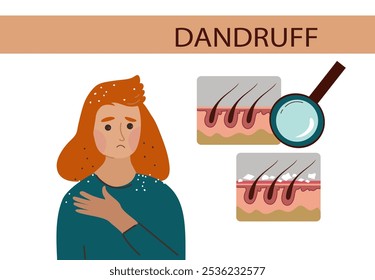 Mulher jovem com problema de caspa. Medicina da saúde, tricologia, conceito dermatológico. Ilustração de desenho plano à mão desenhada em vetor.