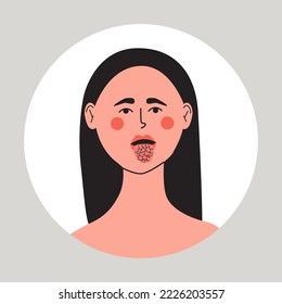 Young woman with dry mouth and tongue, xerostomia problem. Flat vector medical illustration.