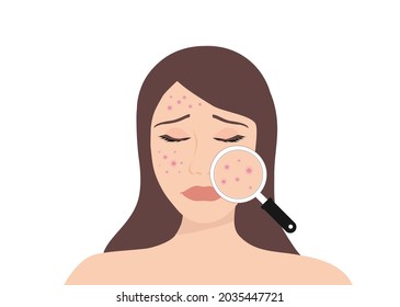 Young woman face with skin acne, pimples, blackheads vector illustration. Acne skin face problem concept