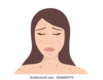 Young woman face with skin acne, pimples, blackheads vector illustration. Acne skin face problem concept