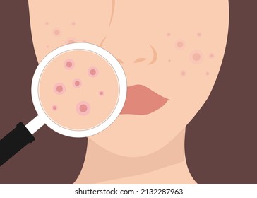 Young woman face with skin acne, pimples, blackheads vector illustration. Acne skin face problem concept