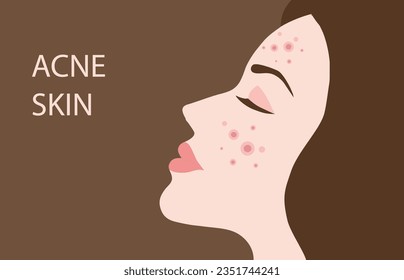 Young woman face with skin acne, pimples, blackheads vector illustration. Acne skin face problem concept