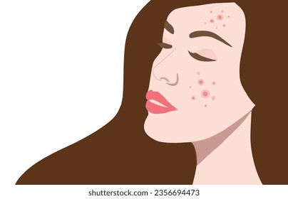 Young woman face with skin acne, pimples, blackheads vector illustration. Acne skin face problem concept