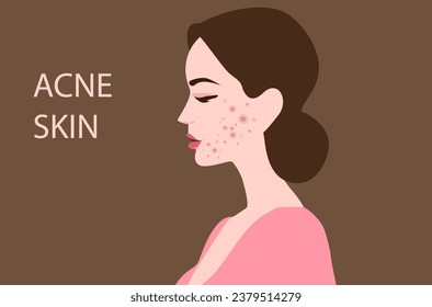 Young woman face with skin acne, pimples, blackheads vector illustration. Acne skin face problem concept