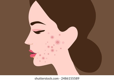 Young woman face with skin acne, pimples, blackheads vector illustration. Acne skin face problem concept