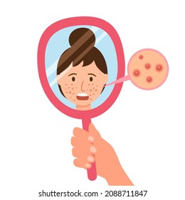 Young woman hand mirror worrying about her acne on face in flat design. Pimple problem on female skin.
