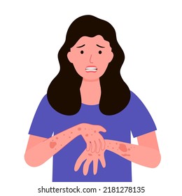 Young woman scratching hand and arm. Female suffering from strong allergy skin itchy symptom in flat design. Red rash skin irritation. Moneypox virus.