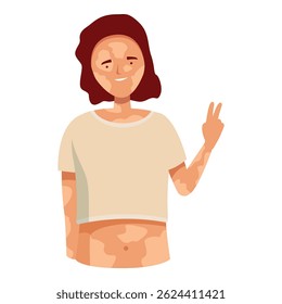 Young woman is showing her vitiligo skin and smiling, body positive, self acceptance and skin pigmentation disorders concept