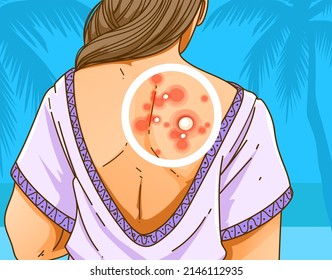 A young woman with skin problems on her back.  Pimple problems. Healthcare illustration, medical infographic. Vector illustration.