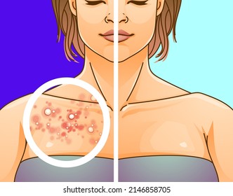 A young woman with skin problems on her chest.  Pimple problems. Before, after. Healthcare illustration, medical infographic.  Vector illustration.