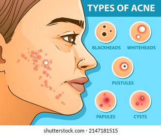 The young woman with skin problems. Pimple problems. Types of acne. Medical infographic. Healthcare illustration. Vector illustration.