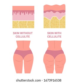 Young woman thighs with and without cellulite. Girl in underwear with smooth and problematic skin on her leg. Healthy and overweight body. Isolated vector illustration in cartoon style