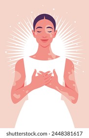 Una joven con vitíligo. Cuerpo positivo. Amor propio y aceptación. Cuerpo positivo. Ilustración plana de Vector