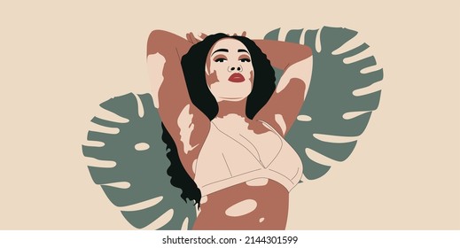 Young woman with vitiligo. Fashionable body positive vector illustration. World vitiligo day concept.